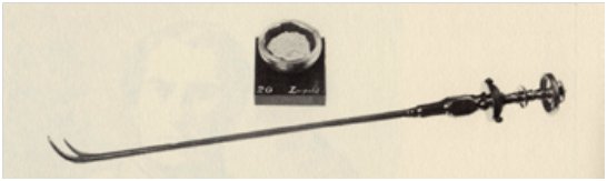 Litotrito usato da Thompson su Napoleone III e Frammento del calcolo estratto