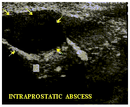 Prostatite acuta - Ecografia transrettale - Ascesso prostatico