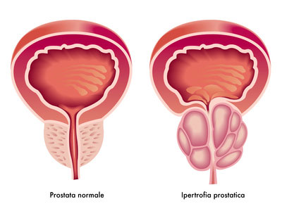 volume normale prostata
