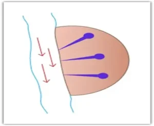Anatomia Patologica della Prostata - Acini e canali minori