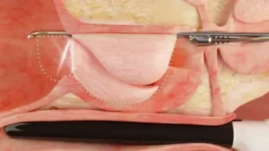 Ipertrofia Prostatica Benigna -Aquablation