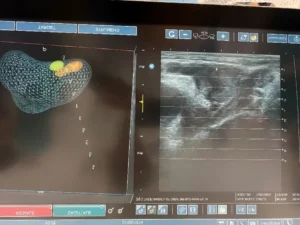 Cancro della Prostata