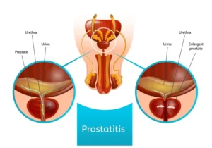 Prostatite Norme comportamentali e dietetiche
