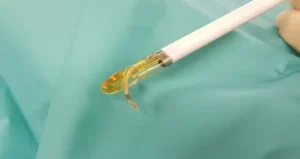 Ipertrofia Prostatica Benigna - Nuove Terapie Chirurgiche (Rezum e Aquablation)
