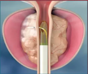 Ipertrofia Prostatica Benigna - Nuove Terapie Chirurgiche (Rezum e Aquablation)