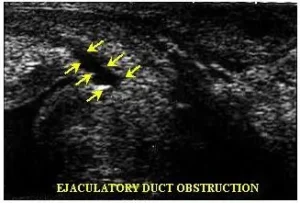 Prostatite cronica e acuta – Metodiche diagnostiche